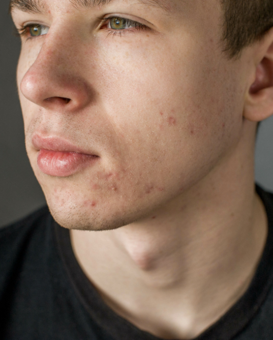 Young man with acne